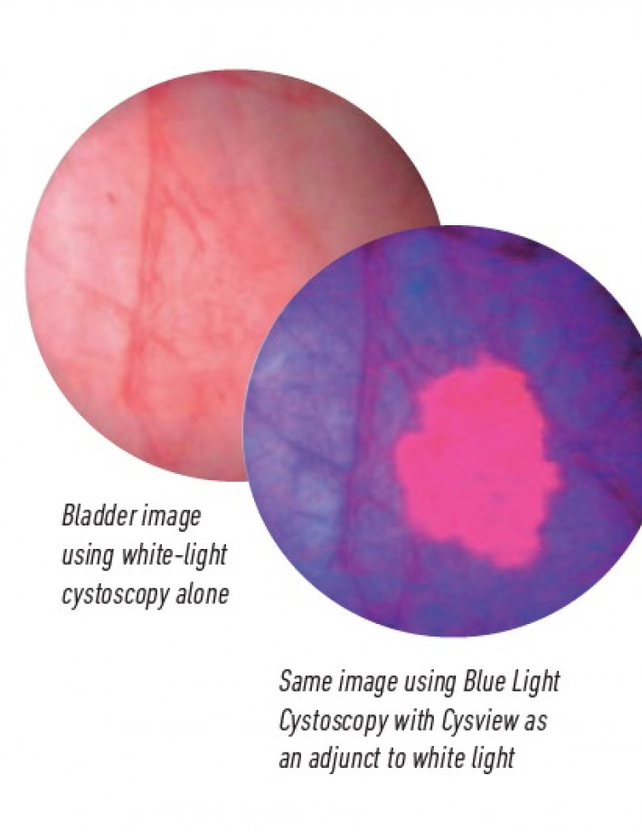 Blue light upptäcker fler cancerfall